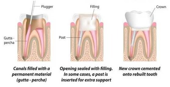 Visual representation of tooth decay stages, emphasizing the need for regular dental check-ups and oral hygiene.	